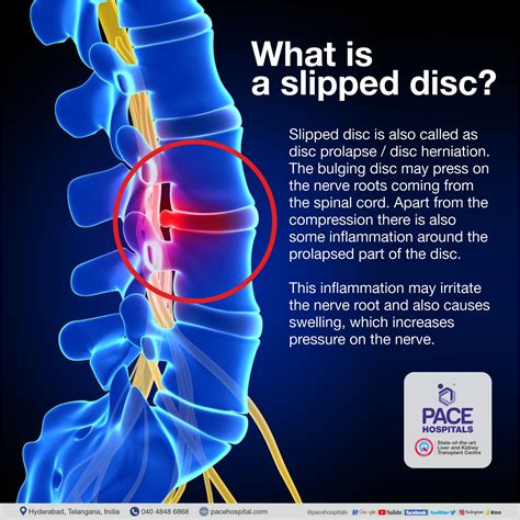 slipped disc music|diagnosing herniated disc.